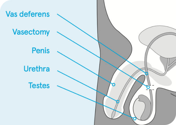 what is vasectomy