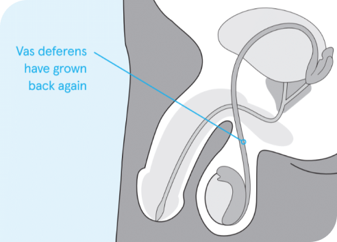 vasectomy failure