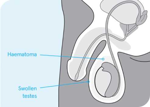 vasectomy complications