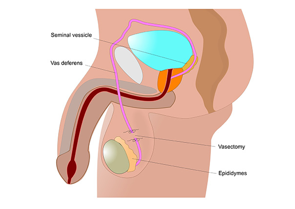 vasectomy Westmead