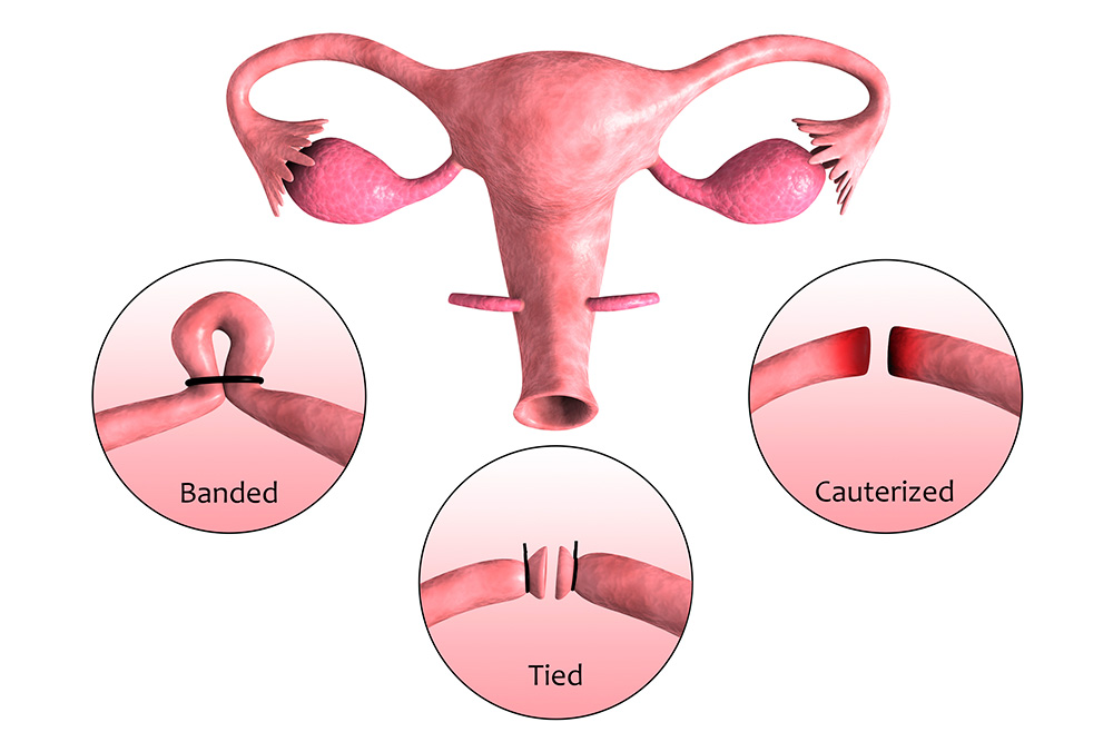 how much does it cost to get your tubes tied