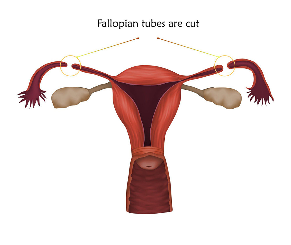 how much does it cost to get your tubes tied