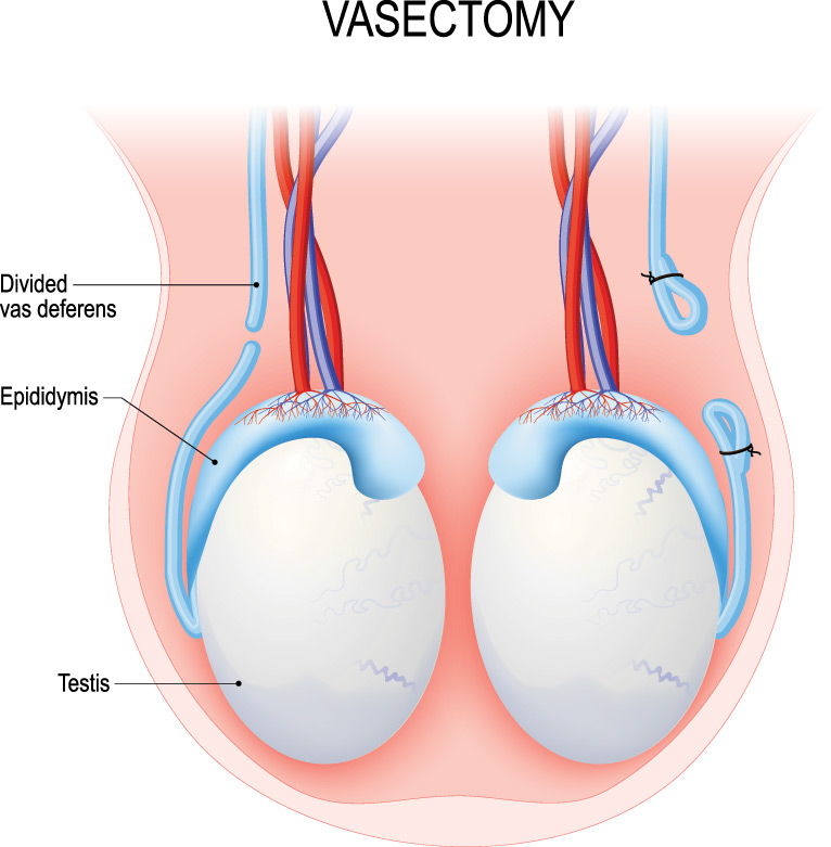 vasectomy clinic Dandenong