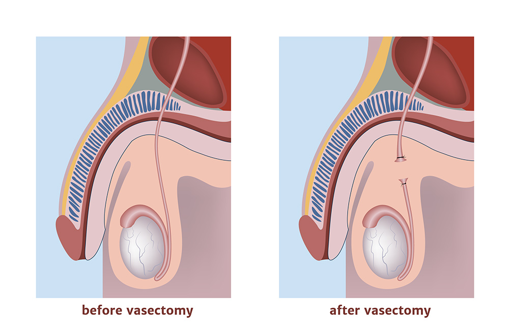 vasectomy caroline springs